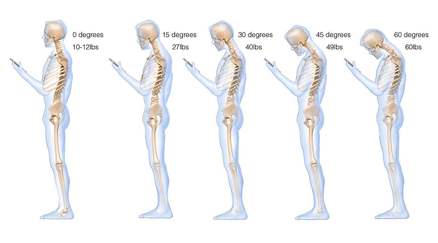 Excessive Texting Causes Neck Pain